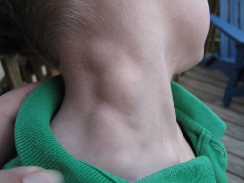 My 5 year old Son had Hodgkins Lymphoma, Cancer. - Meredith Rowlen ...